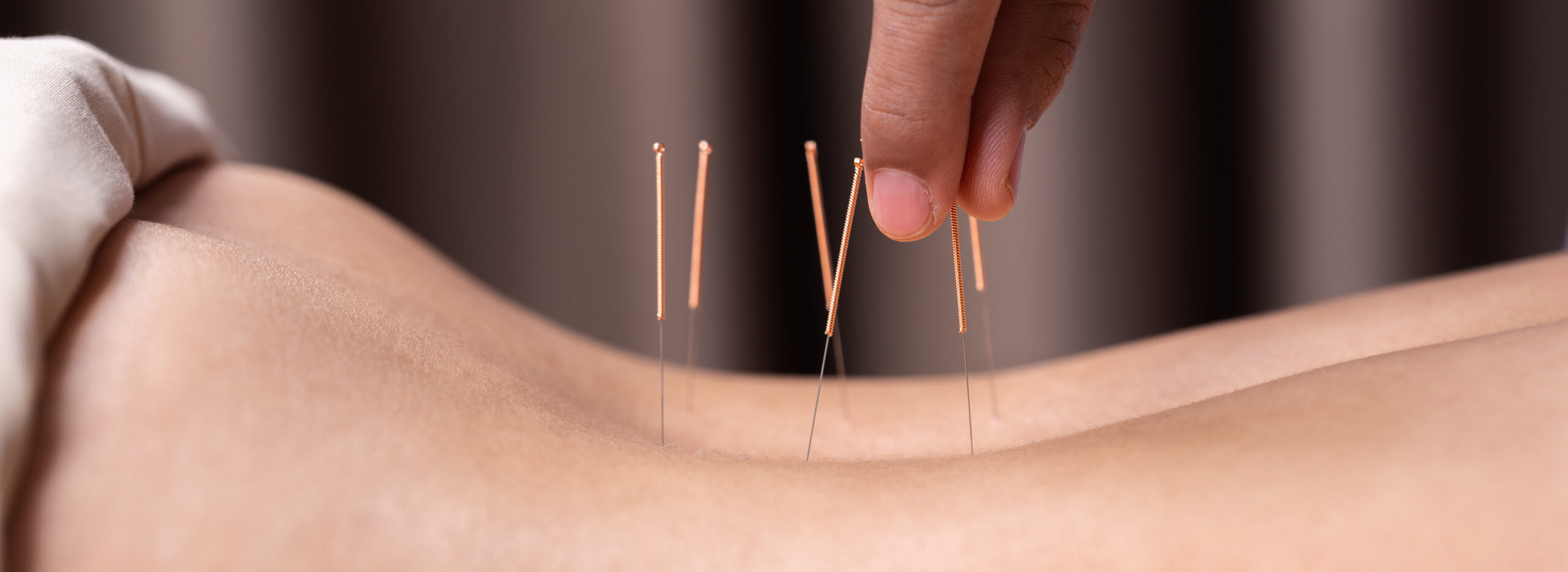 woman undergoing acupuncture treatment on back
